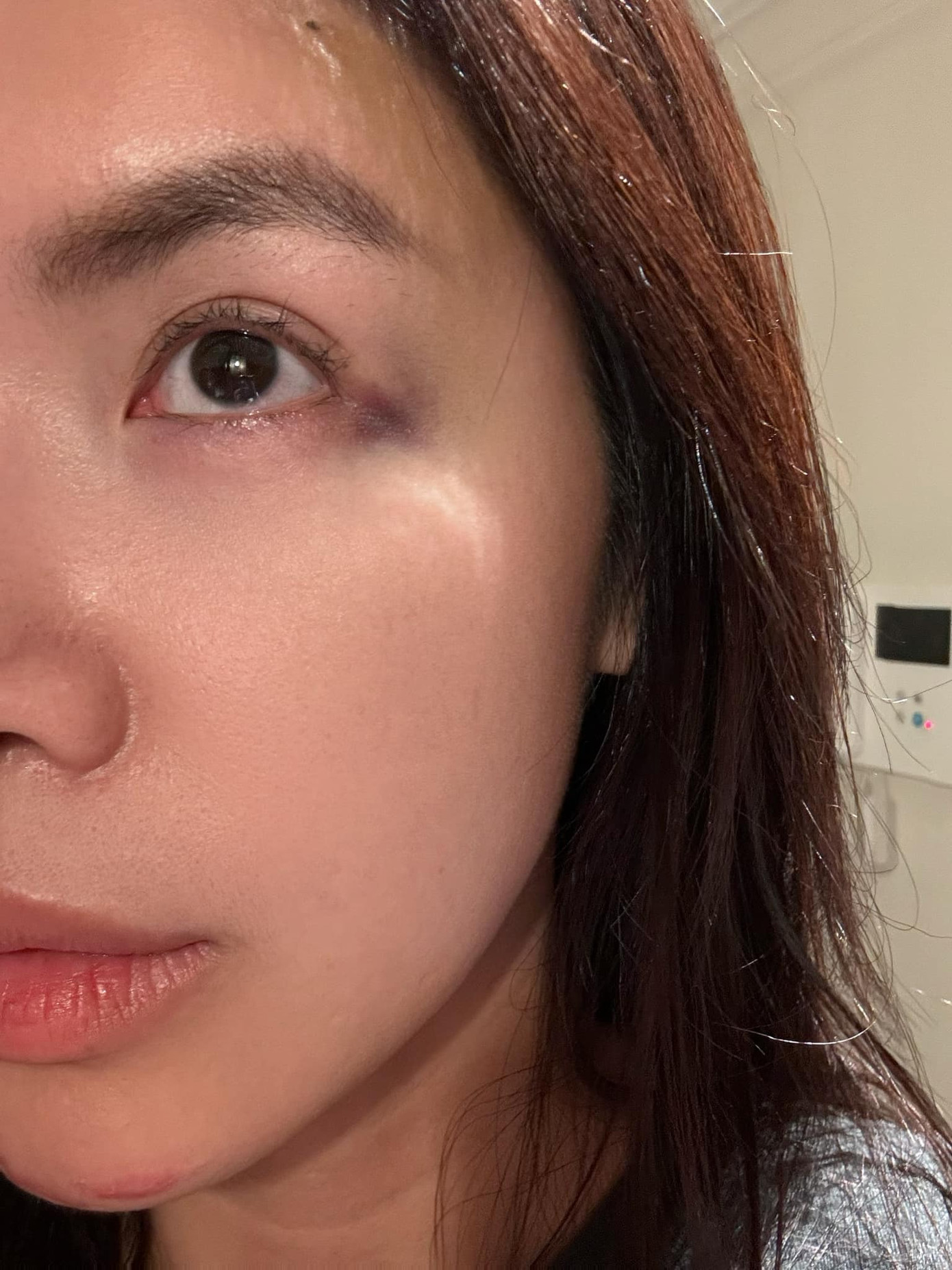 Minh Tú không rõ lý do chấn thương sau bữa tiệc.