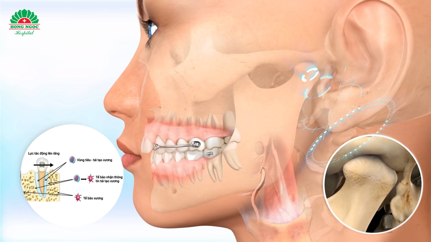 Niềng răng sinh học là phương pháp niềng răng rất khó, đòi hỏi sự khắt khe về mặt chuyên môn và khí cụ thực hiện. Niềng răng sinh học là phương pháp niềng răng rất khó, đòi hỏi sự khắt khe về mặt chuyên môn và khí cụ thực hiện.