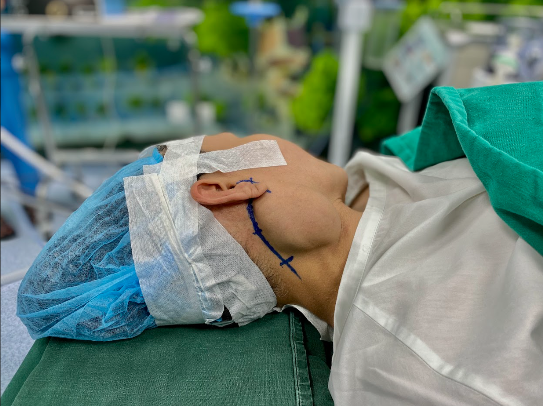 Hình ảnh thực tế khối u tuyến nước bọt mang tai kích thước khổng lồ tới 10cm của bệnh nhân