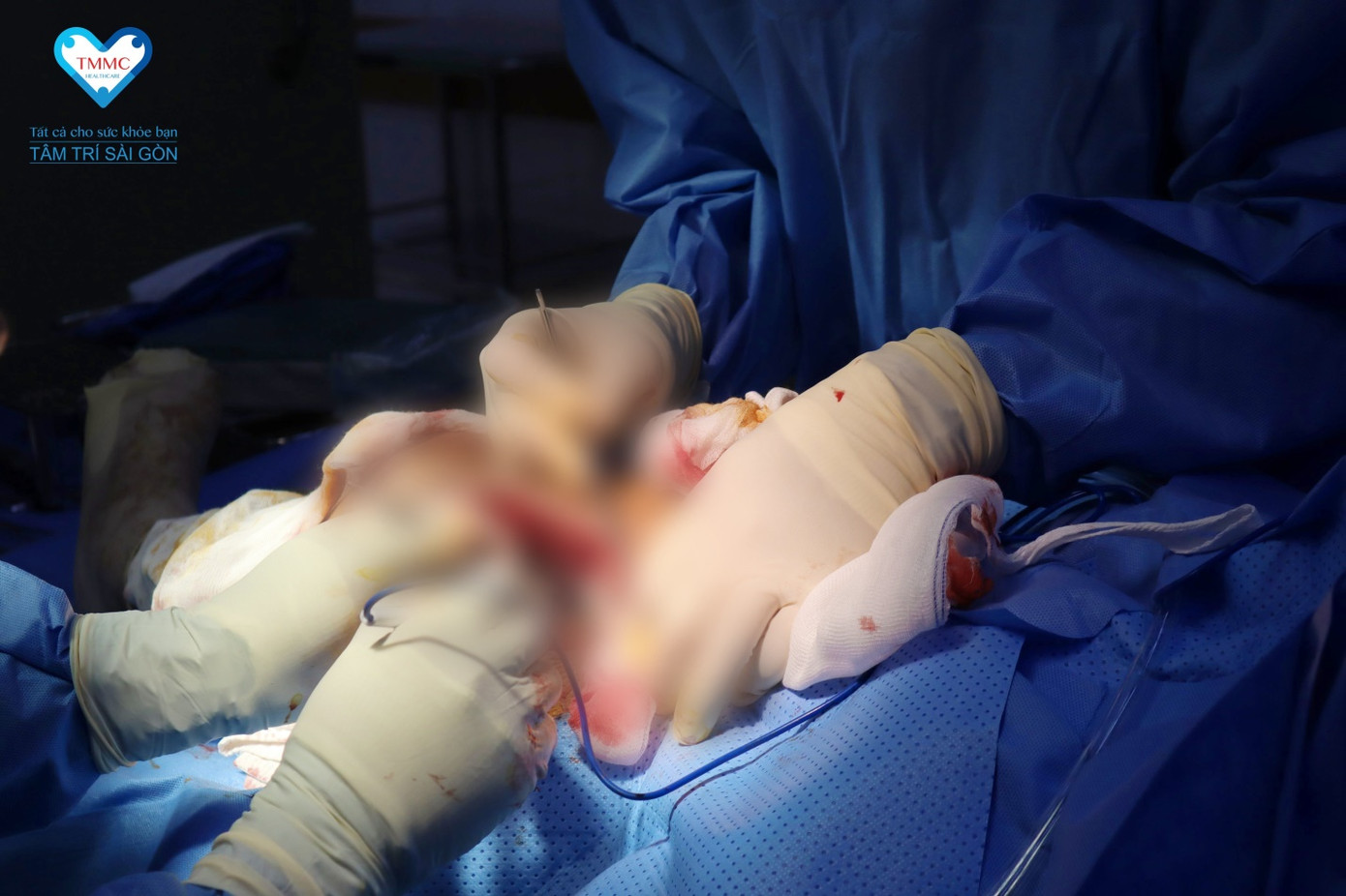 Bác sĩ BVĐK Tâm Trí Sài Gòn tiến hành phẫu thuật cấp cứu