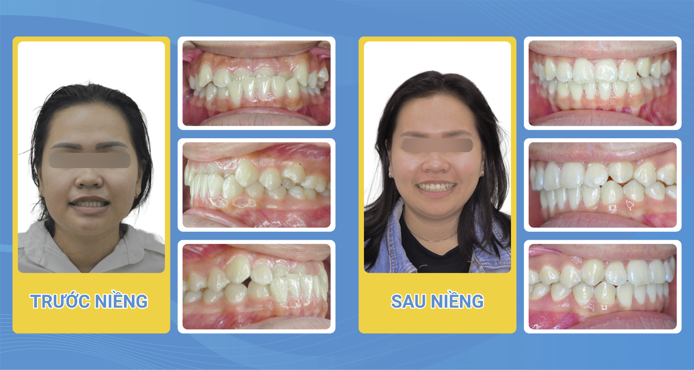 Khách hàng đã niềng răng thành công tại Dr. Vương - Niềng răng đẹp Khách hàng đã niềng răng thành công tại Dr. Vương - Niềng răng đẹp