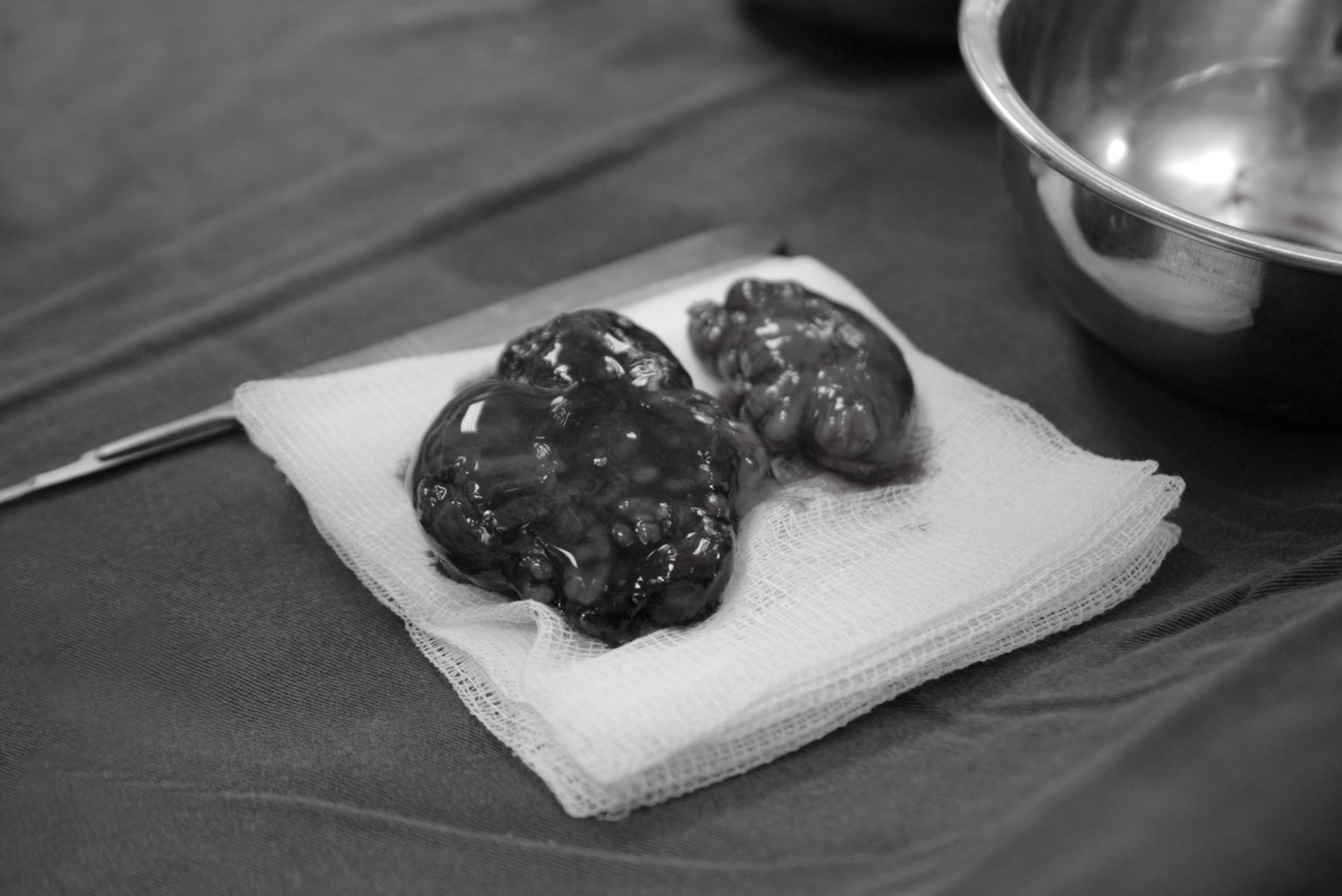 Hai khối u tuyến nước bọt mang tai của bệnh nhân đã được nạo vét hoàn toàn