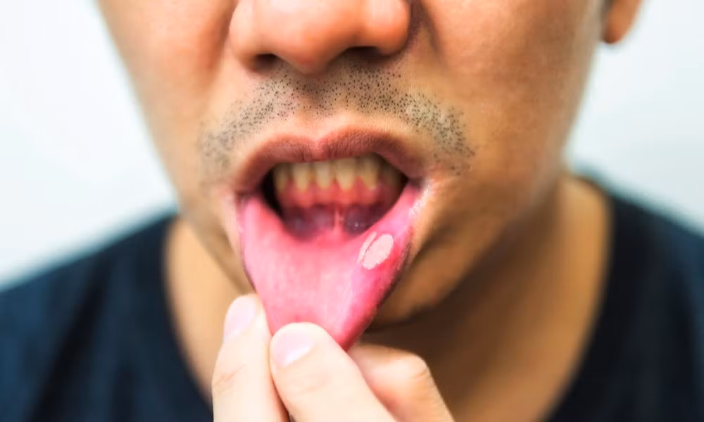 Cảnh báo: Phát hiện 'thủ phạm' mới gây ung thư miệng ảnh 1