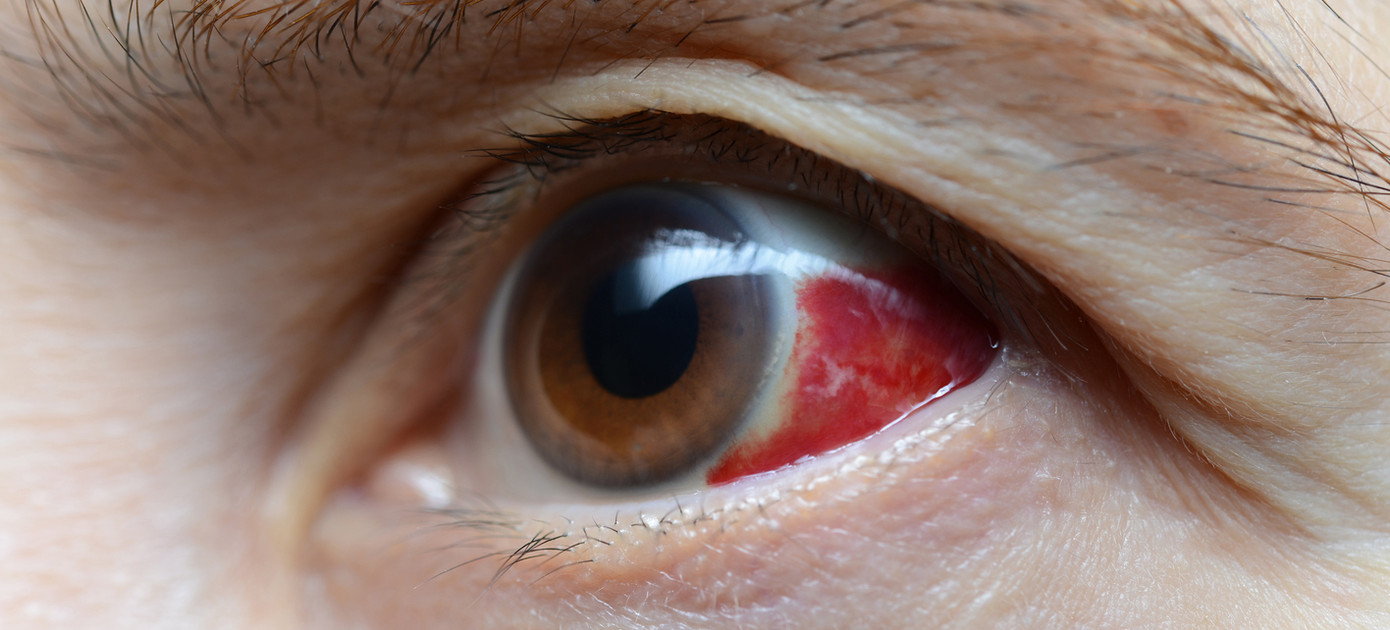 Nạn nhân bệnh võng mạc tiểu đường rất dễ bị xuất huyết mắt thời gian thụ hưởng cực khoái.