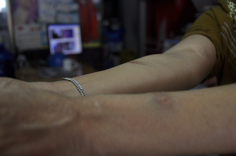 Vết thương trên tay chị Lê Thị Thúy Nga do tên cướp để lại