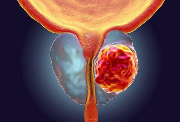 Phì đại tiền liệt tuyến là bệnh lý thường gặp ở nam giới độ tuổi từ 50 trở lên