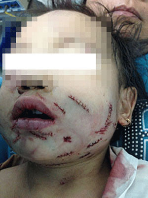 Thương tâm bé gái 8 tuổi bị chó cắn rách mặt ảnh 1