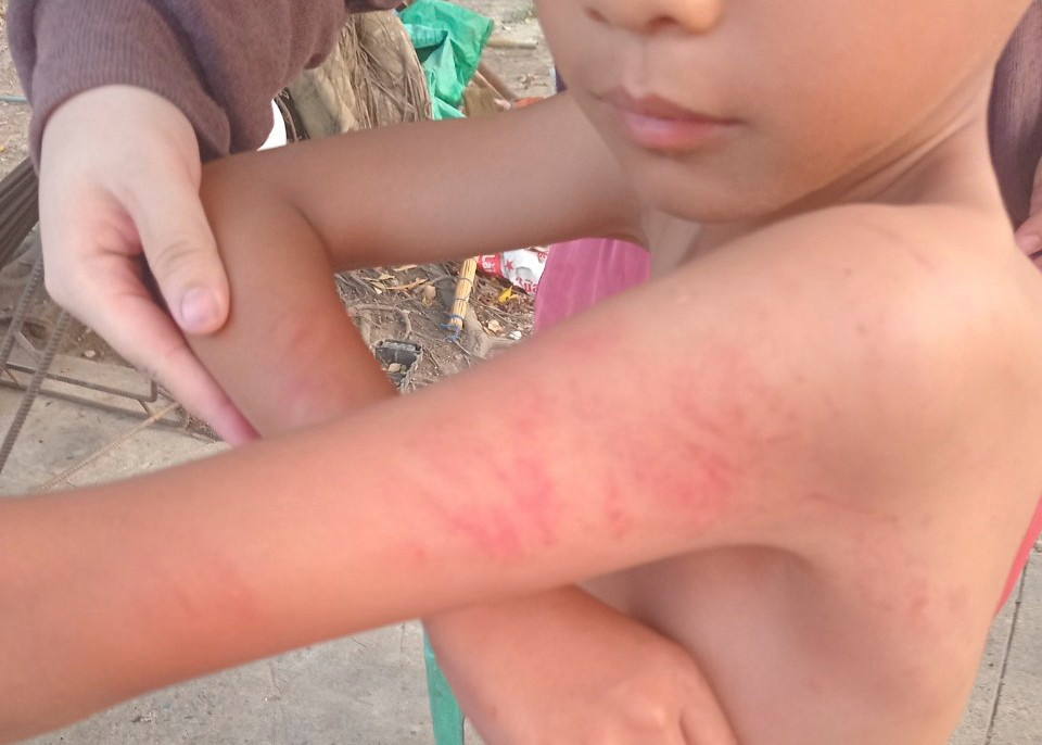 Học sinh lớp 1 bị cô giáo đánh với các vết bầm hiện trên da. Ảnh: CTV