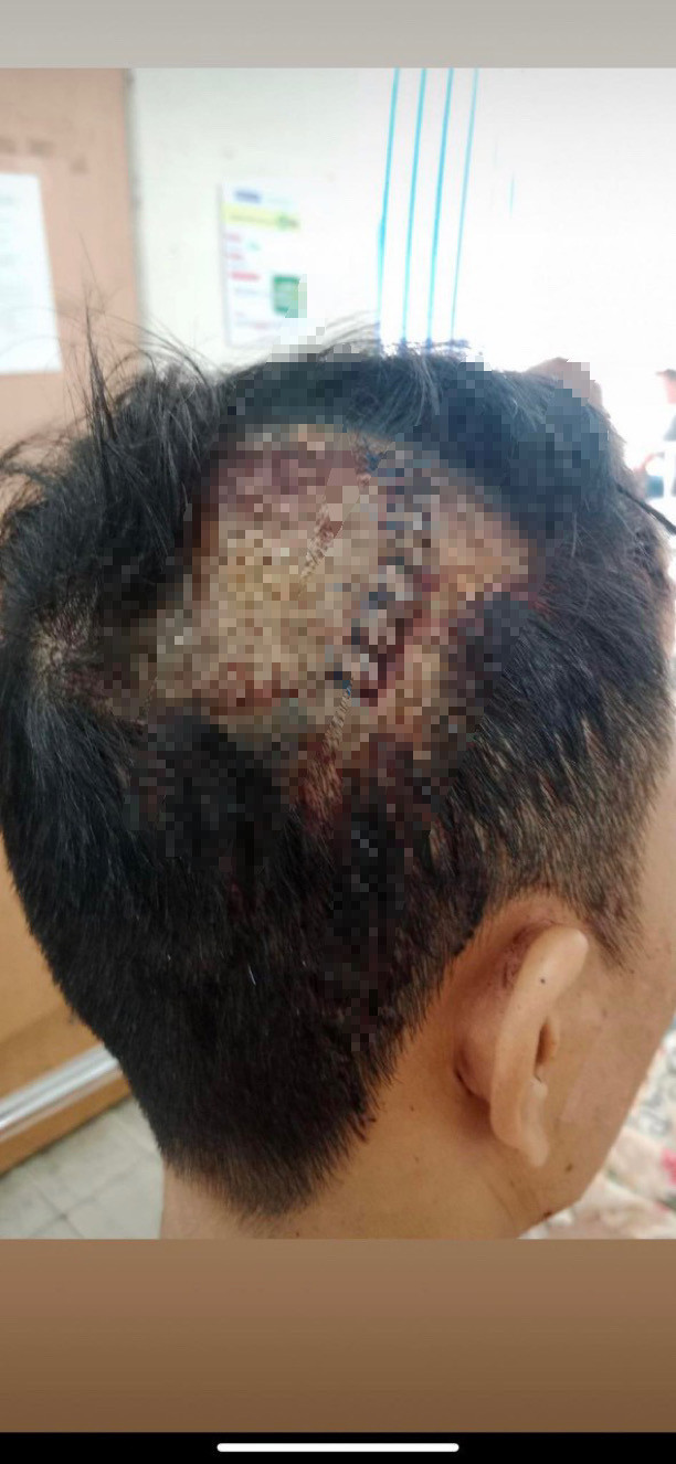 Phần đầu may nhiều mũi của nạn nhân.(Ảnh: NNCC)