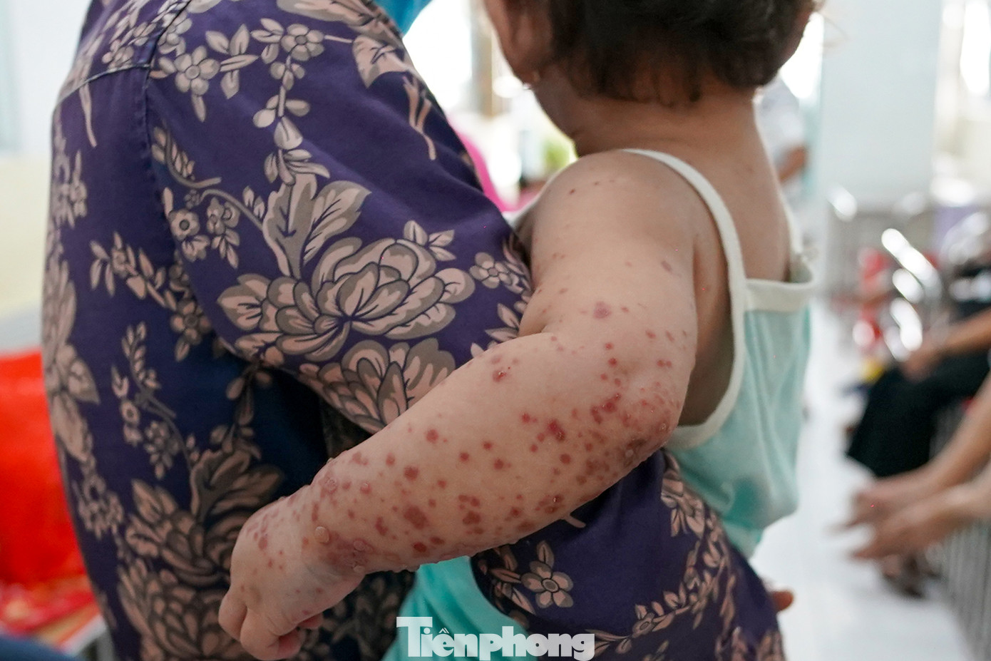 Những trẻ có biểu hiện bệnh phụ huynh cần đưa đến bệnh viện để được thăm khám, điều trị. Trẻ đã được chẩn đoán mắc tay chân miệng hoặc chưa được chẩn đoán xác định nếu có biểu hiện sốt cao khó hạ, tay chân hoặc vùng miệng nổi bóng nước, giật mình chới với khi ngủ, lơ mơ, đi đứng loạng choạng… phụ huynh cần nhanh chóng đưa trẻ đến bệnh viện để được chẩn đoán, điều trị kịp thời.