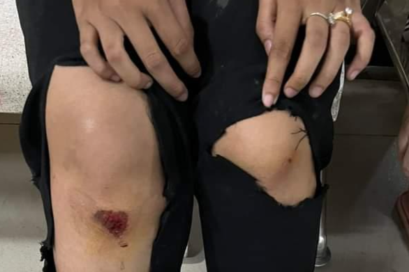 B.N bị nhiều vết thương ở đầu gối.