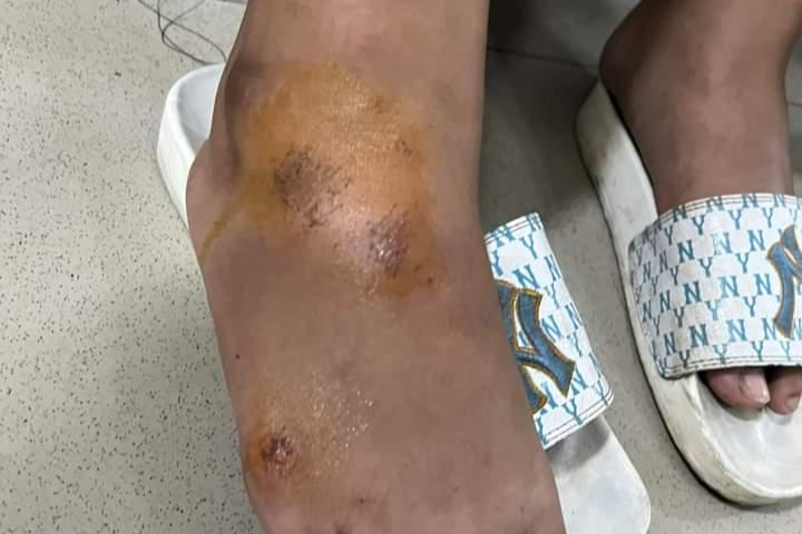 Chấn thương phần mềm té xe.