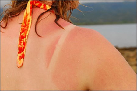 Những điều cần biết để “cấp cứu” làn da cháy nắng ảnh 2