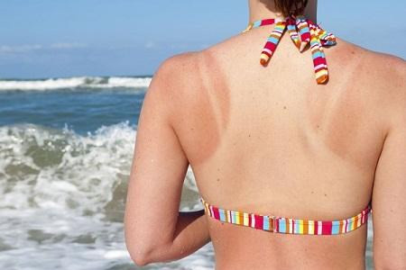 Những điều cần biết để “cấp cứu” làn da cháy nắng ảnh 3