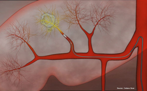 Các hạt vi cầu phóng xạ được bơm trực tiếp vào động mạch nuôi u, giúp làm giảm thể tích hoặc tiêu hoàn toàn khối u gan. Ảnh:Cancerautralia. ungthugan1-7907-1435654867.jpg
