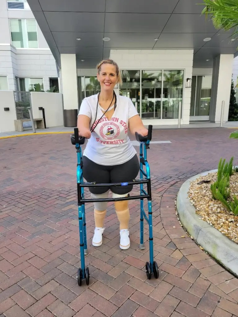 Bà Fox bị cụt tay và chân sau khi bị cúm và mất hơn một năm để trở về cuộc sống bình thường.