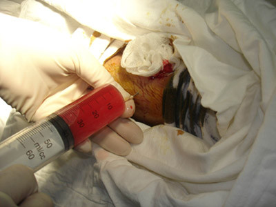 Tiêm tế bào gốc vào ổ căng giãn xương để làm nhanh quá trình liền xương. Tiêm tế bào gốc vào ổ căng giãn xương để làm nhanh quá trình liền xương