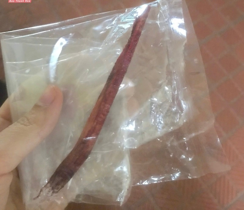 Dị vật được rút ra khỏi cổ của bệnh nhân