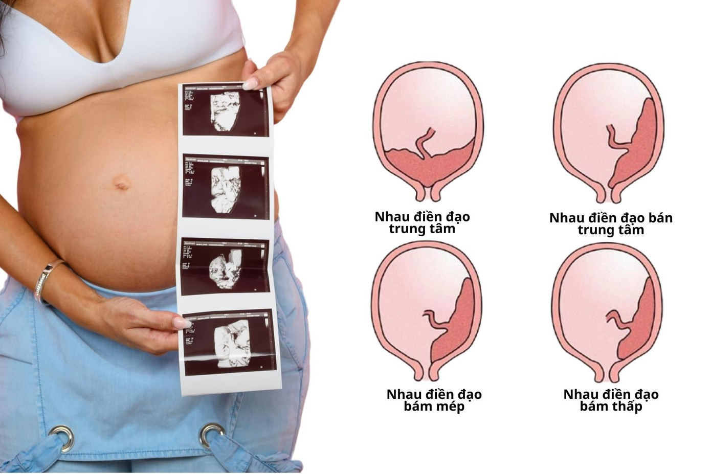 Các loại nhau tiền đạo.