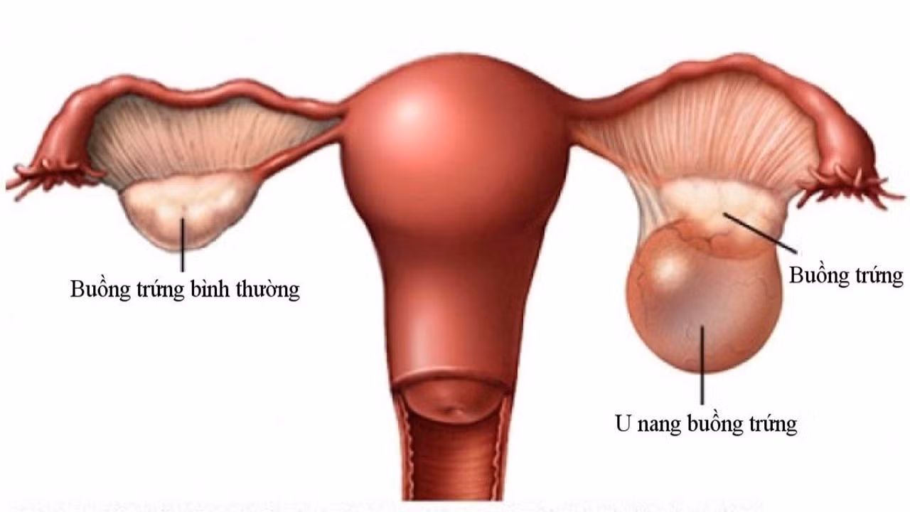 Hình ảnh minh họa bệnh u nang buồng trứng.