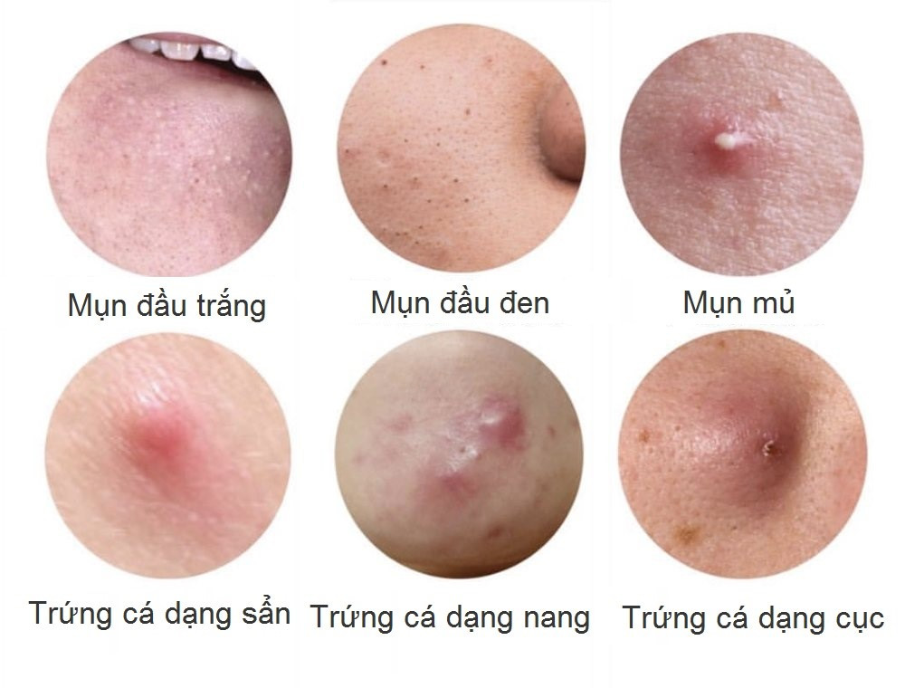 Các loại mụn trứng cá thường gặp. Các loại mụn trứng cá thường gặp.
