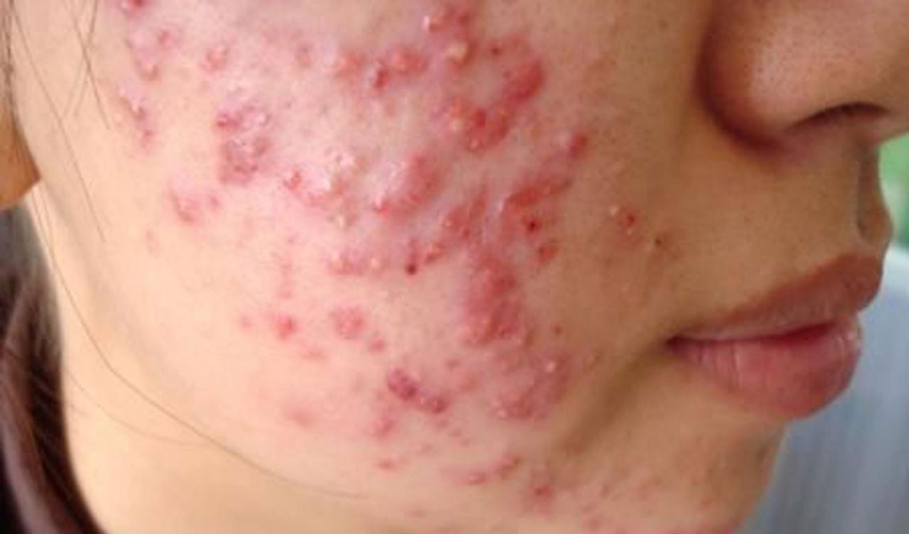 Mụn trứng cá tuy không nguy hiểm nhưng gây mất thẩm mỹ, ảnh hưởng trực tiếp đến chất lượng sống của bệnh nhân. Mụn trứng cá tuy không nguy hiểm nhưng gây mất thẩm mỹ, ảnh hưởng trực tiếp đến chất lượng sống của bệnh nhân.