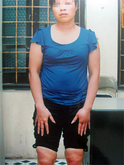 Nạn nhân một vụ vay lãi suất cao, chậm trả và bị đánh đập tại quận Hai Bà Trưng. Nạn nhân một vụ vay lãi suất cao, chậm trả và bị đánh đập tại quận Hai Bà Trưng