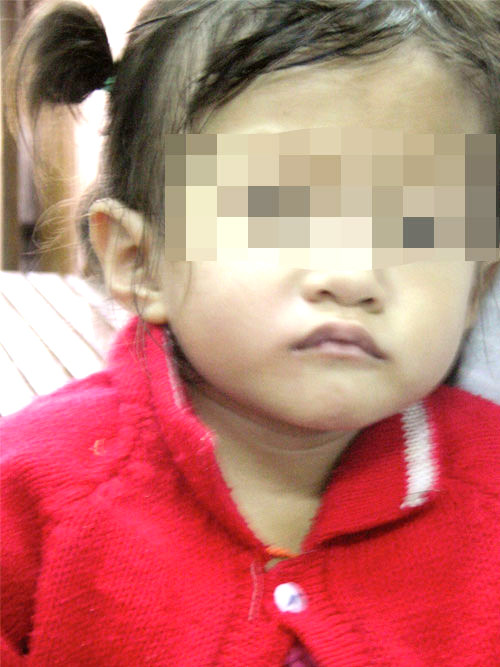 Cháu T.T.H. - nạn nhân của những chai xi rô ho Théralene