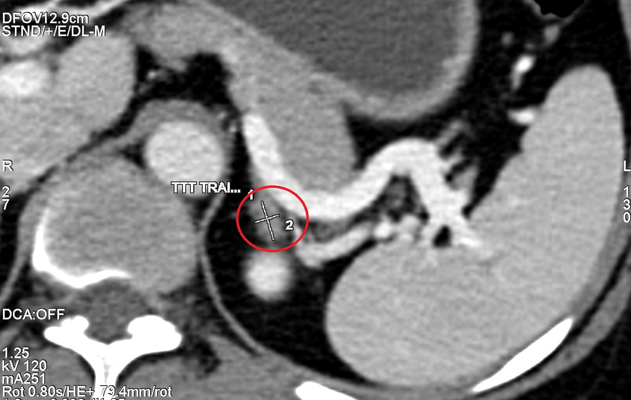 Hình ảnh chụp CT 2560 lát cắt phát hiện khối u tuyến thượng thận trái kích thước 10mm của bệnh nhân T