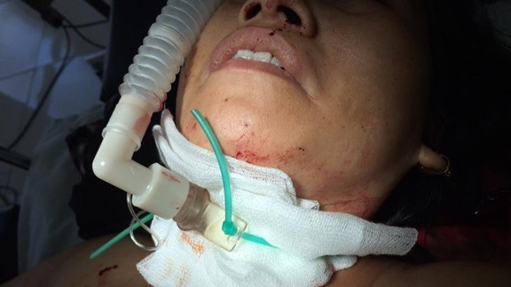 Bị cứa cổ, một phụ nữ nguy kịch ảnh 1