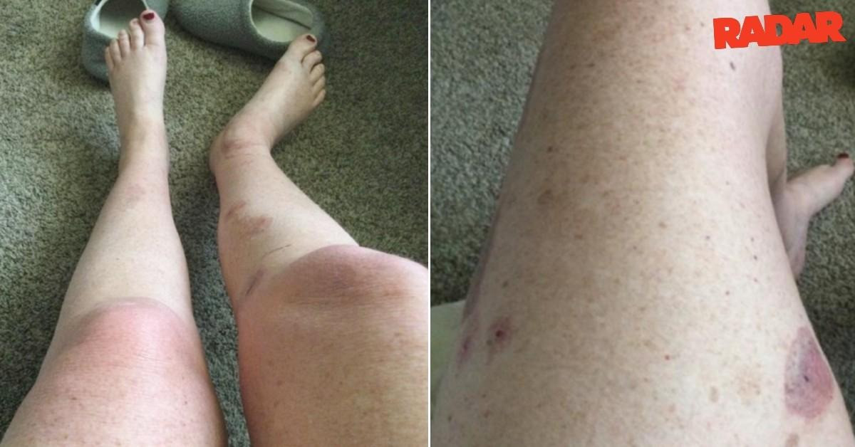 Tình trạng cơ thể của Patrick sau khi dùng muối tắm theo công thức do Meghan tạo ra. Ảnh: Radar Online.