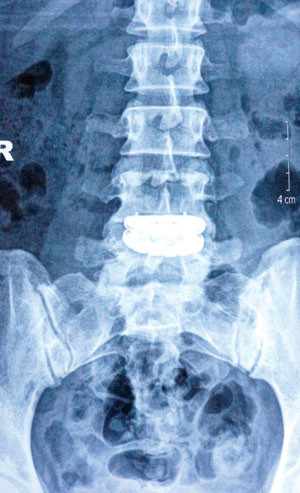 Phim chụp vị trí thay đĩa đệm nhân tạo