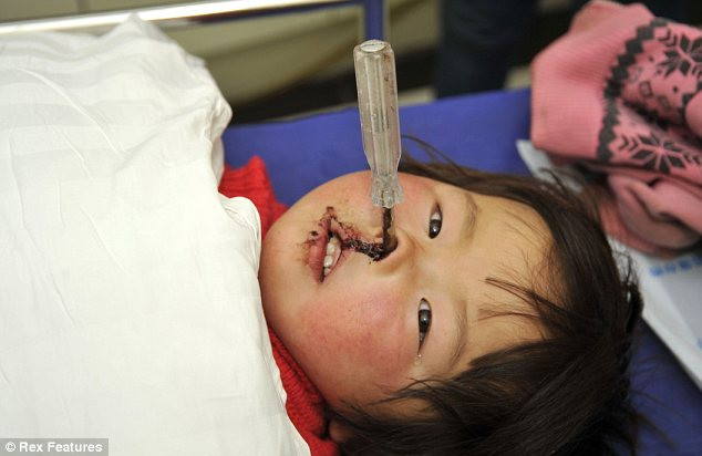 Bé gái Jiali bị chiếc tua vít đâm sâu vào mũi . Bé gái Jiali bị chiếc tua nơ vít đâm sâu vào mũi