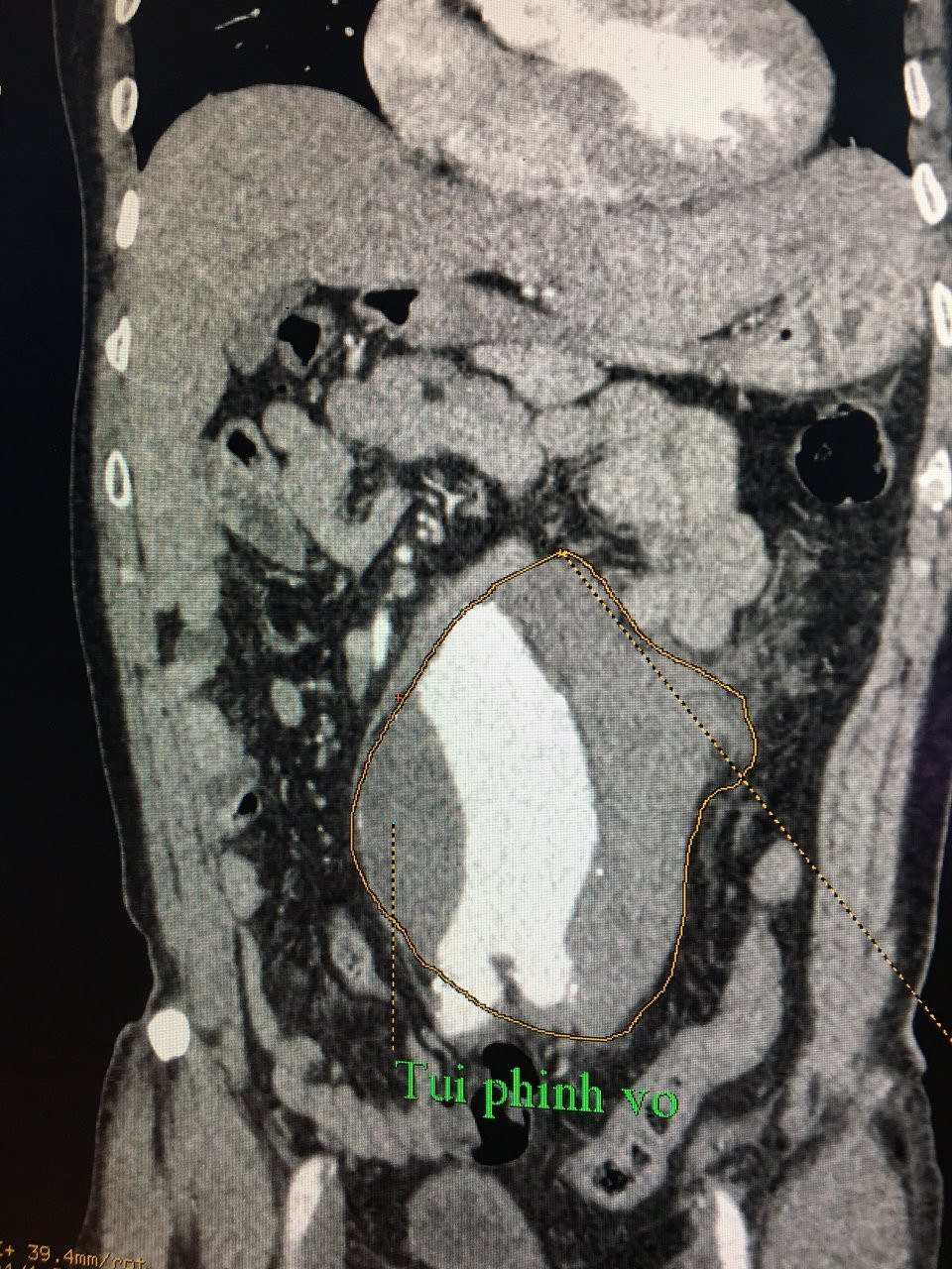 Suýt chết vì phát hiện khối u quanh rốn đập theo nhịp tim nhưng không đi khám ảnh 1