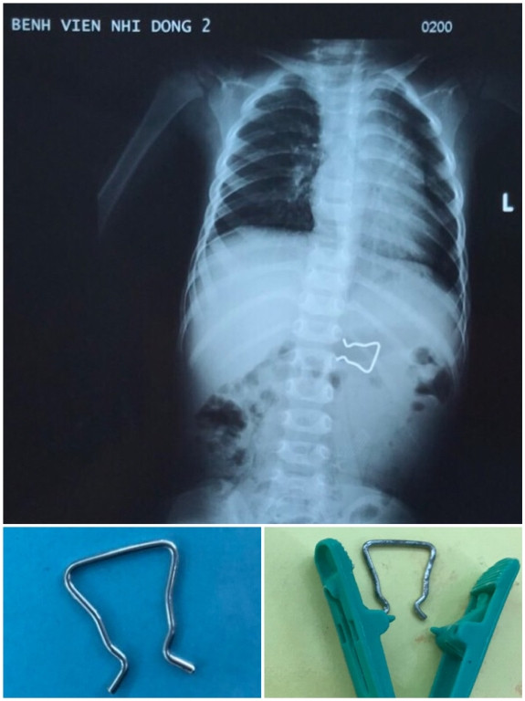 Nuốt móc sắt kẹp quần áo, bé trai 18 tháng suýt thủng ruột ảnh 1