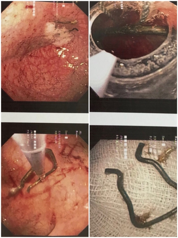 Nuốt móc sắt kẹp quần áo, bé trai 18 tháng suýt thủng ruột ảnh 2