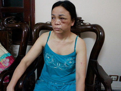 Bà Hợp với thương tích trên người, kể lại sự việc với phóng viên