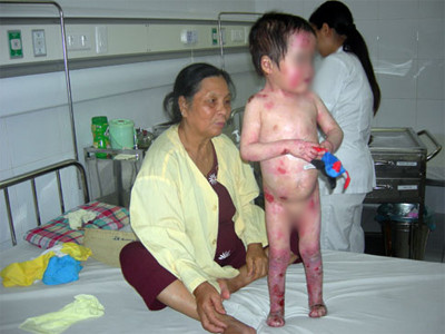 Bệnh nhi N.V.A., 4 tuổi, 11kg. Theo bà nội bé, ngay cả việc thay quần áo cho V.A. cũng làm bé nhiều khi rất đau đớn. Ảnh: N.Hà