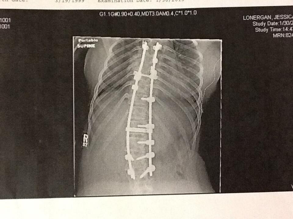 Ảnh điều trị cột sống của Jessica Ảnh điều trị cột sống của Jessica