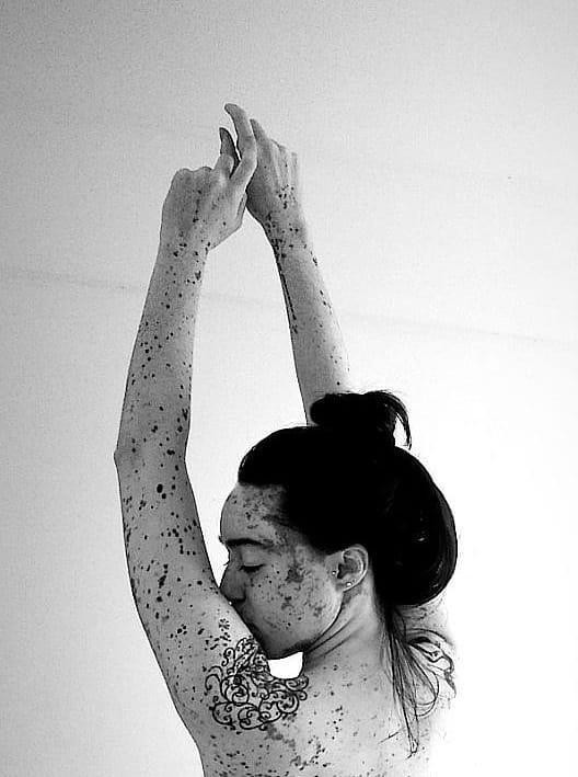 Thay vì né tránh hay mặc cảm khi nhắc về vấn đề của bản thân, Stephanie đã chấp nhận khiếm khuyết của bản thân và cởi mở hơn trong việc chia sẻ hình ảnh Thay vì né tránh hay mặc cảm khi nhắc về vấn đề của bản thân, Stephanie đã chấp nhận khiếm khuyết của bản thân và cởi mở hơn trong việc chia sẻ hình ảnh