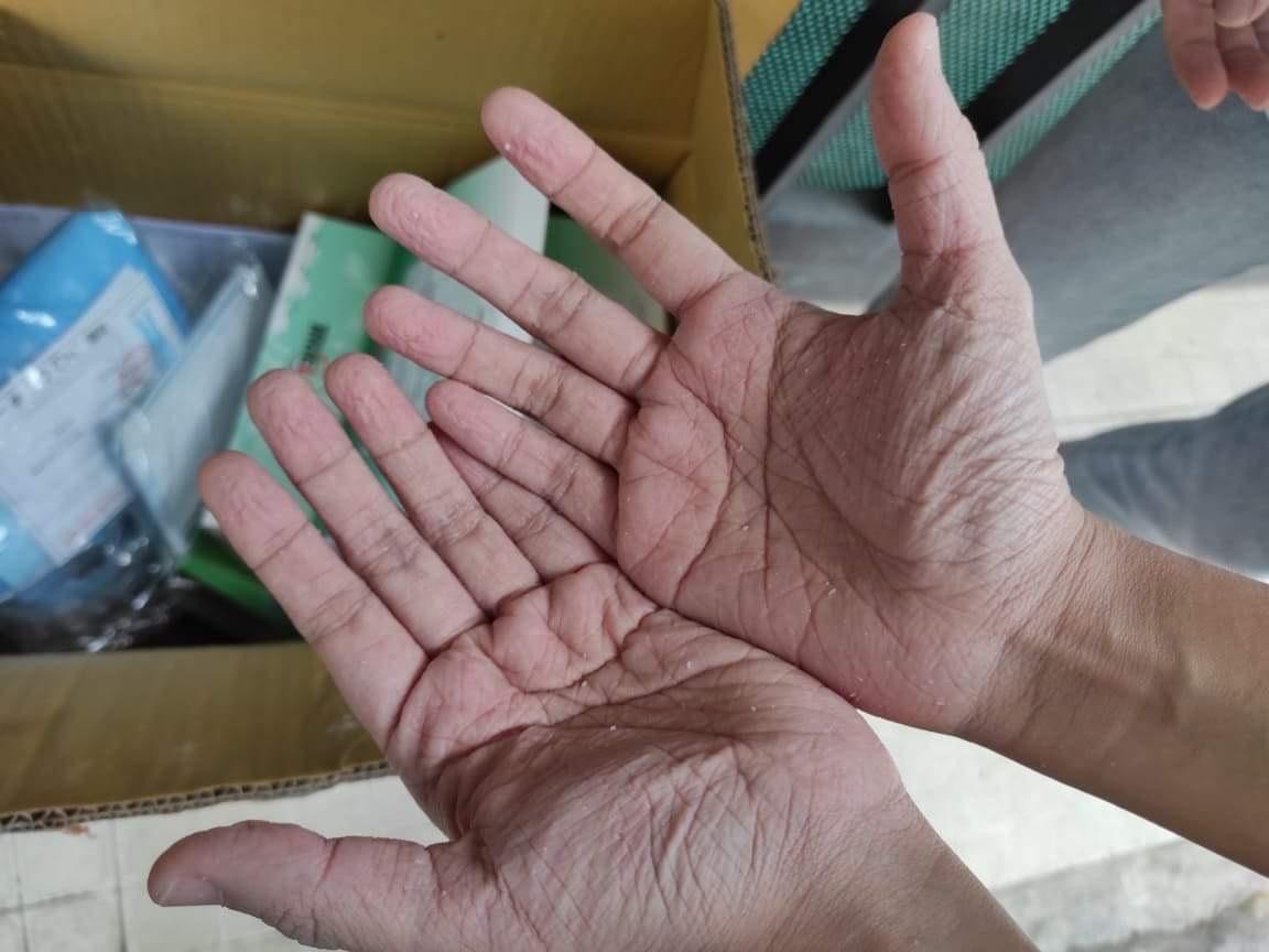 Bàn tay nhăn nhúm, trắng bệch lại sau 12 tiếng làm việc trong bộ đồ bảo hộ