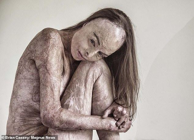 Tuy nhan sắc và sức khỏe đã bị ngọn lửa hung tàn năm ấy cướp đi, nhưng ý chí và nghị lực sống phi thường đã giúp Carol nhanh chóng vượt lên