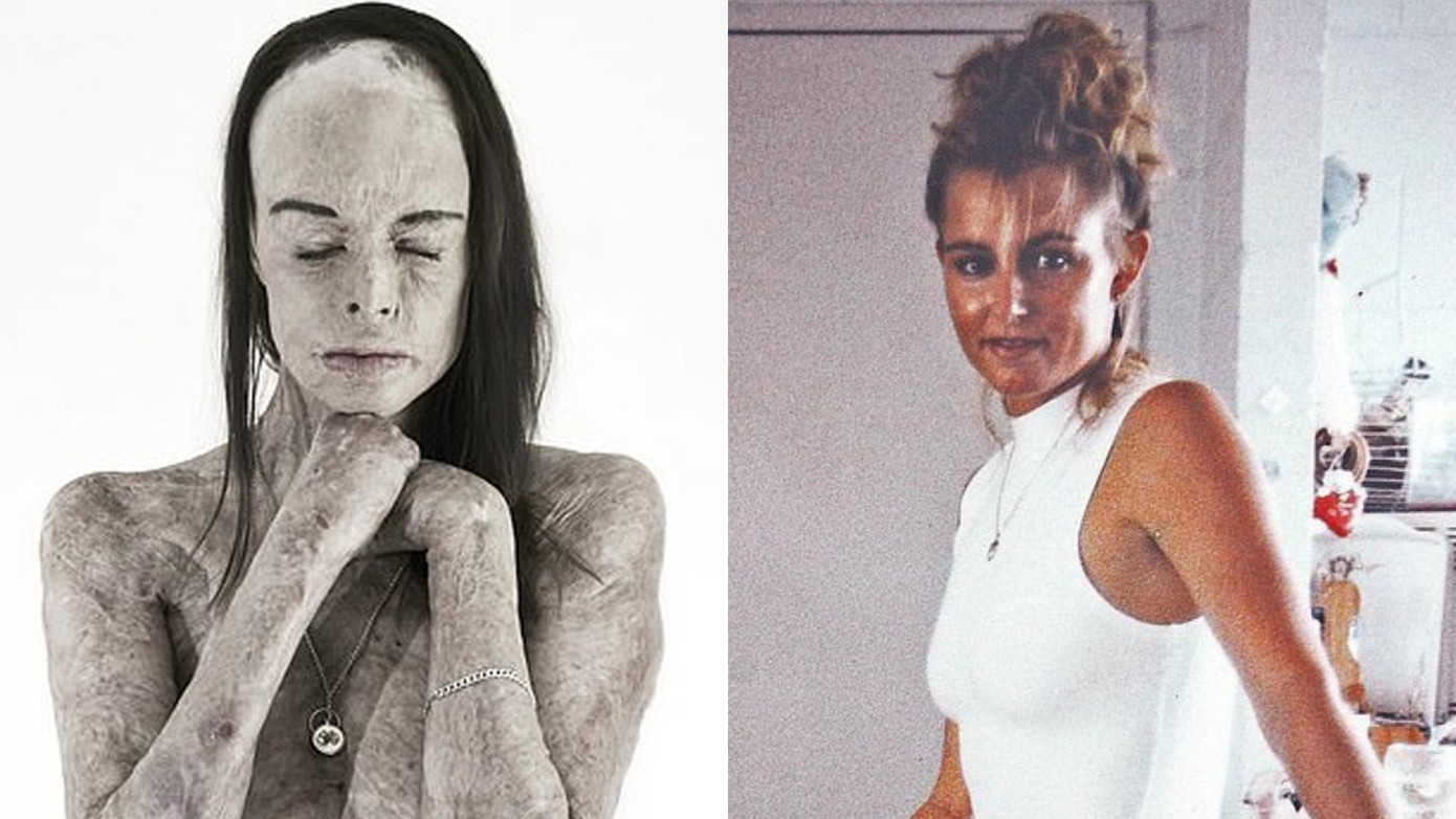 Carol Mayer trước và sau khi bị bỏng