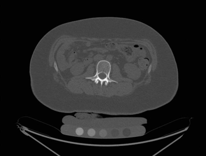 Mật độ xương kém do cắt dạ dày (Ảnh: EA)