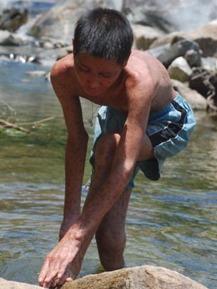 Một bệnh nhân mắc bệnh tắm rửa tại suối Ranh - nguồn nước sinh hoạt của nhiều người dân làng Rêu, xã Ba Điền, huyện Ba Tơ, Quảng Ngãi. Ảnh: Việt Hùng 