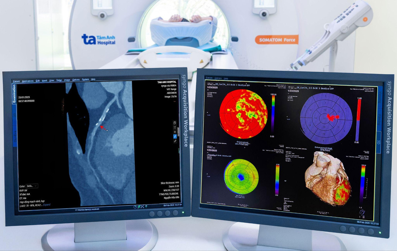Hình ảnh chụp CT mạch vành (bên trái) và bản đồ tưới máu cơ tim (bên phải) của người bệnh trên phim chụp CT Somatom Force VB30, hỗ trợ đắc lực cho bác sĩ khi chẩn đoán bệnh. Nguồn ảnh: BVĐK Tâm Anh