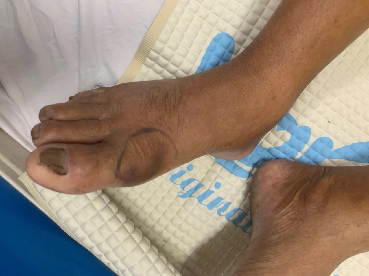 Cụ ông 70 tuổi ở Bạc Liêu bị rắn hổ đất cắn đã qua cơn nguy kịch. Cụ ông 70 tuổi ở Bạc Liêu bị rắn hổ đất cắn đã qua cơn nguy kịch.