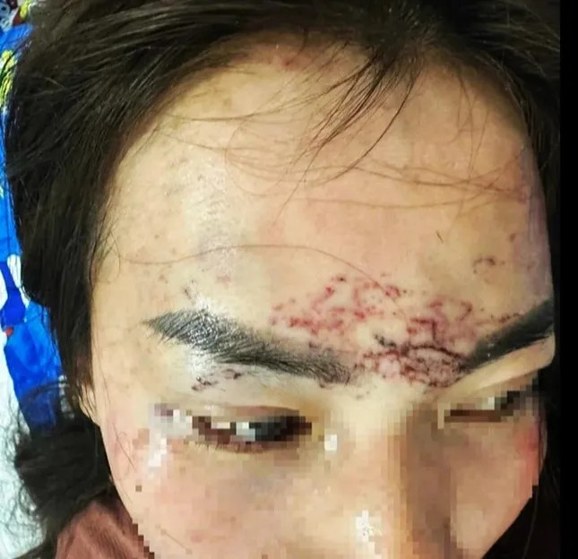 Nạn nhân cho rằng do ghen tuông nên đã đánh và xăm lên mặt.