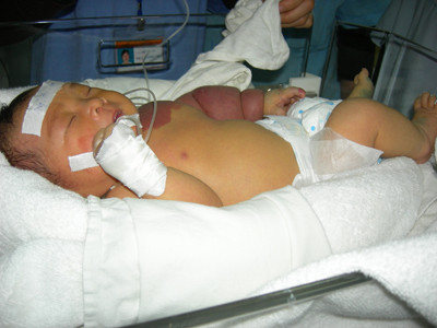 Bé An đang được điều trị tại BV Nhi Trung ương