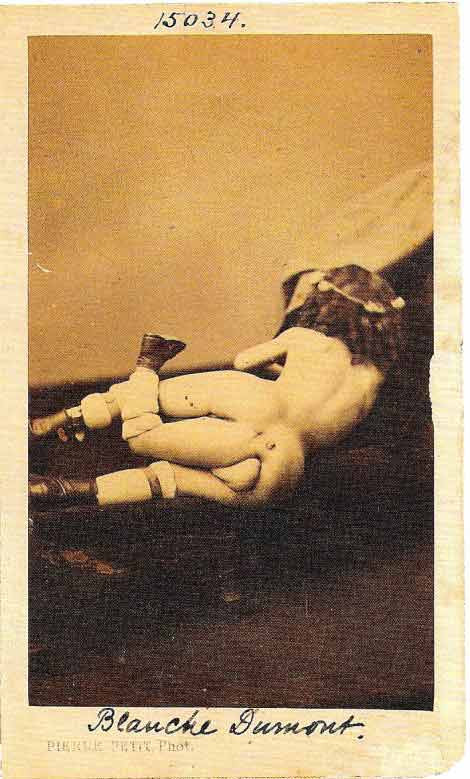 Cấu tạo đặc biệt của Blanche Dumas trước và sau.